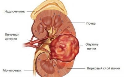 Гіпернефрома нирки: прогноз і лікування светлоклеточного гипернефроидного раку лівої і правої нирок