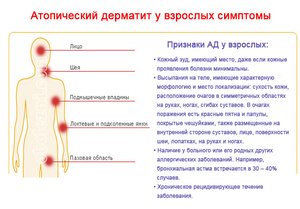 Атопічний дерматит у дорослих: причини, симптоми, лікування препаратами і народними засобами