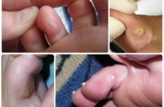 Хворобливі мозолі між пальцями ніг: особливості, причини появи й способи лікування