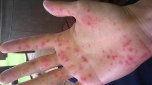 Алергія на руках від миючих засобів: між пальцями, симптоми, причина та лікування
