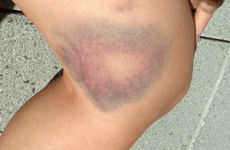 Гематома на нозі після удару: причини і симптоми, лікування