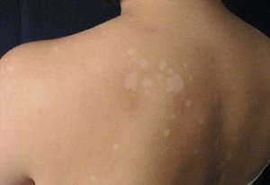 Чому на шкірі зявляються білі плями: як позбутися білих плям на тілі