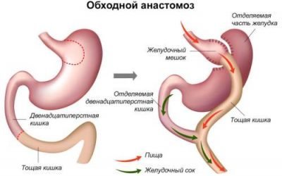 Види анастомозів на кишечнику і вибір оптимального варіанту
