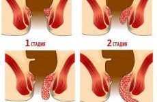 Шишка, кулька в задньому проході (в анусі, на попі) у чоловіків і жінок: причини і лікування