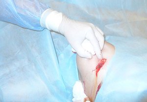 Серома післяопераційного рубця: причини появи серозної рідини під швом, можливі ускладнення та лікування