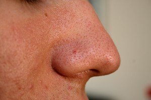 Простудні прищі: види прищів на обличчі і їх лікування, причини утворення
