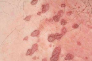 ВПЛ 16 типу у жінок: діагностика папіломавірусу, симптоми і чи можна вилікувати