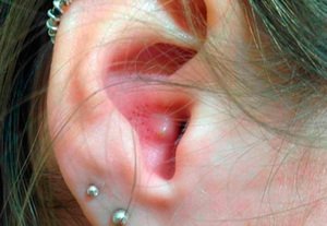 Прищі у вухах: симптоми та причини виникнення, методи лікування