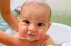 Яка буває висипки навколо рота у дитини: причини виникнення і лікування висипань