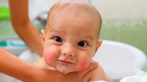 Яка буває висипки навколо рота у дитини: причини виникнення і лікування висипань