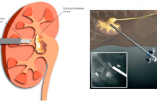 Дроблення каменів в сечоводі: хірургічне лікування сечокам’яної хвороби ультразвуком – операція по видаленню каменя з сечового міхура у чоловіків