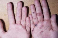 Бульозний епідермоліз: причини захворювання, види, лікування