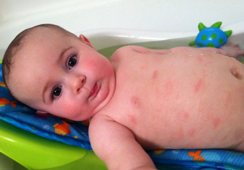 Атопічний дерматит у немовлят: причини, ефективне лікування