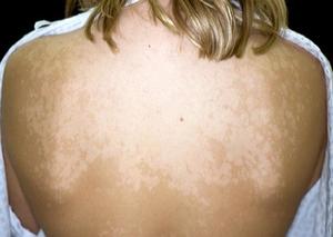 Як вилікувати сонячний грибок на шкірі у людини, позбавляючи профілактика