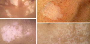 Білі пігментні плями на тілі: причини формування, поява білястих плям на шкірі щік, рук і спини дитини