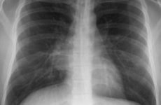 Ліпома в легенях (кардиодиафрагмального кута праворуч, середостіння, парастернальная): причини, як позбутися
