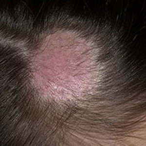 Що таке мікоз шкіри і як його лікувати: основні симптоми грибкового захворювання, лікування та профілактика