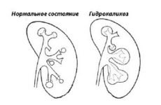 Гідрокалікоз нирок: хвороба лівої і правої нирки — що це таке