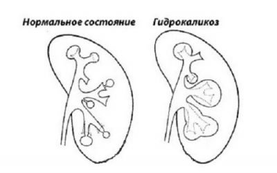 Гідрокалікоз нирок: хвороба лівої і правої нирки — що це таке
