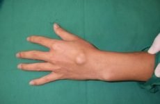 Гігрома на зап’ясті руки: причини появи шишки на кисті і симптоми, лікування новоутворення