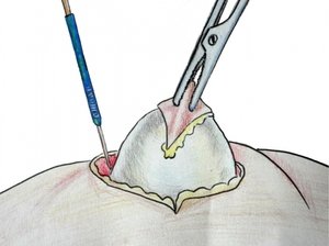 Атерома на обличчі та голові: причини утворення кісти сальної залози, способи лікування та хірургічне видалення