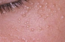 Міліуми на обличчі: лікування, методи видалення новоутворень та причини виникнення на шкірі