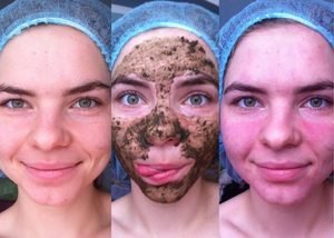 Особливості застосування бодяги для особи: маски і пілінги бодягою, відгуки косметологів