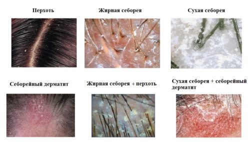 Себорейний дерматит волосистої частини голови