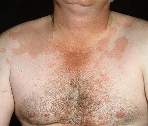 Плями на шкірі: як виглядають симптоми хвороб печінки, сірі і червоні плями, лікування хвороб печінки