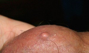 Жировик на яєчках: причини появи, способи лікування ліпоми під шкірою на мошонці і заходи профілактики