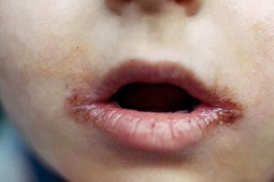 Білі плями на губах: причини появи точок і пухирців, як позбутися проблеми