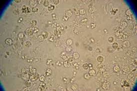 Лейкоцити в спермограмі правила дослідження характеристики стандарт небезпека хвороби лікування