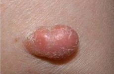 Різновиди фіброми шкіри: причини виникнення, симптоми, прояв м’яких і твердих утворень