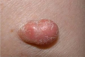 Різновиди фіброми шкіри: причини виникнення, симптоми, прояв мяких і твердих утворень