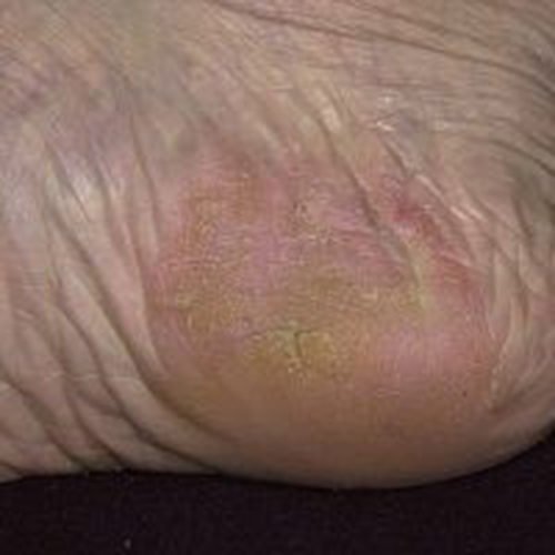 Дерматит на ногах: фото, види, причини появи, лікування