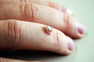 Симптоми шипицы на руках: причини і лікування, наслідки болячки на пальці