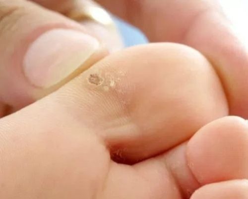 Шипица на нозі: дізнайтеся причини і найбільш ефективне лікування
