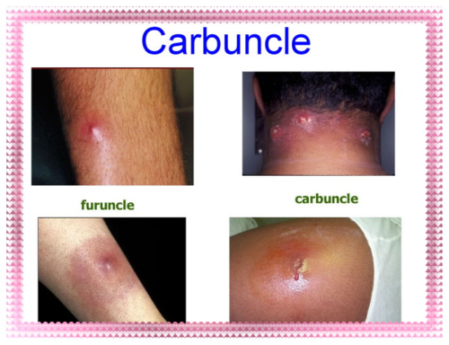 Фурункул і карбункул: причини, стадії, симптоми, лікування