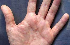 Дисгідрозі кистей рук: симптоматика та причини появи, лікування і профілактика, протипоказання і дієта
