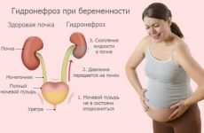 Гідронефроз правої або лівої нирок при вагітності: причини і симптоми гідронефрозу 2 ступеня правої нирки