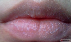 Білі плями на губах: причини появи точок і пухирців, як позбутися проблеми