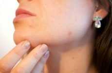 Алергічні прищі на обличчі: причини, лікування, як швидко позбутися від алергії у вигляді прищів