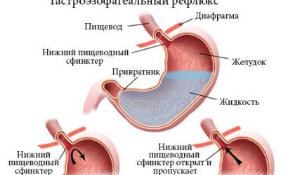 Пілороспазм у дорослих і дітей (новонароджених, грудних): симптоматика, діагностика і лікування