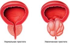 Неповне спорожнення сечового міхура у чоловіків лікування причини методи діагностика лікування допомогу