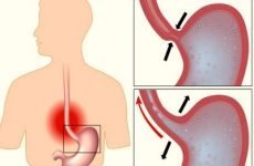 Недостатність кардії шлунка (кардіальний жом змикаються не повністю): симптоми і лікування