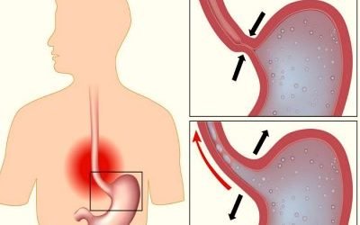 Недостатність кардії шлунка (кардіальний жом змикаються не повністю): симптоми і лікування
