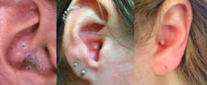 Прищі у вухах: симптоми та причини виникнення, методи лікування