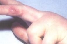 Герпес на руках: причини виникнення та різновиди, симптоми і ускладнення, лікування та профілактика