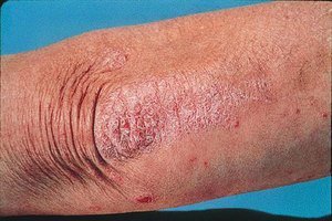 Причини сухої шкіри на ліктях, кращі народні засоби для лікування сухості і тріщин