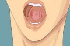 Прищі на і в горлі: причини і лікування. Як позбутися гнійних, червоних чи білих прищиків в горлі